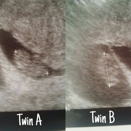Probably the bigger indicator is the gestational sac is well <b>behind</b>. . Measuring 3 days behind at 7 weeks ivf